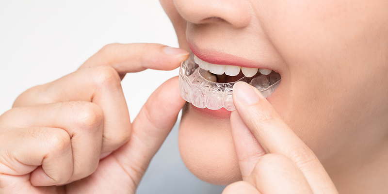 The Benefits of Invisalign: A Clear Choice for Straightening Your Teeth